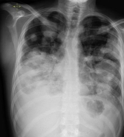 solid cystic lung mass