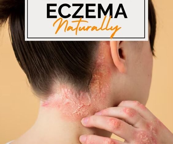 dermadrate for eczema